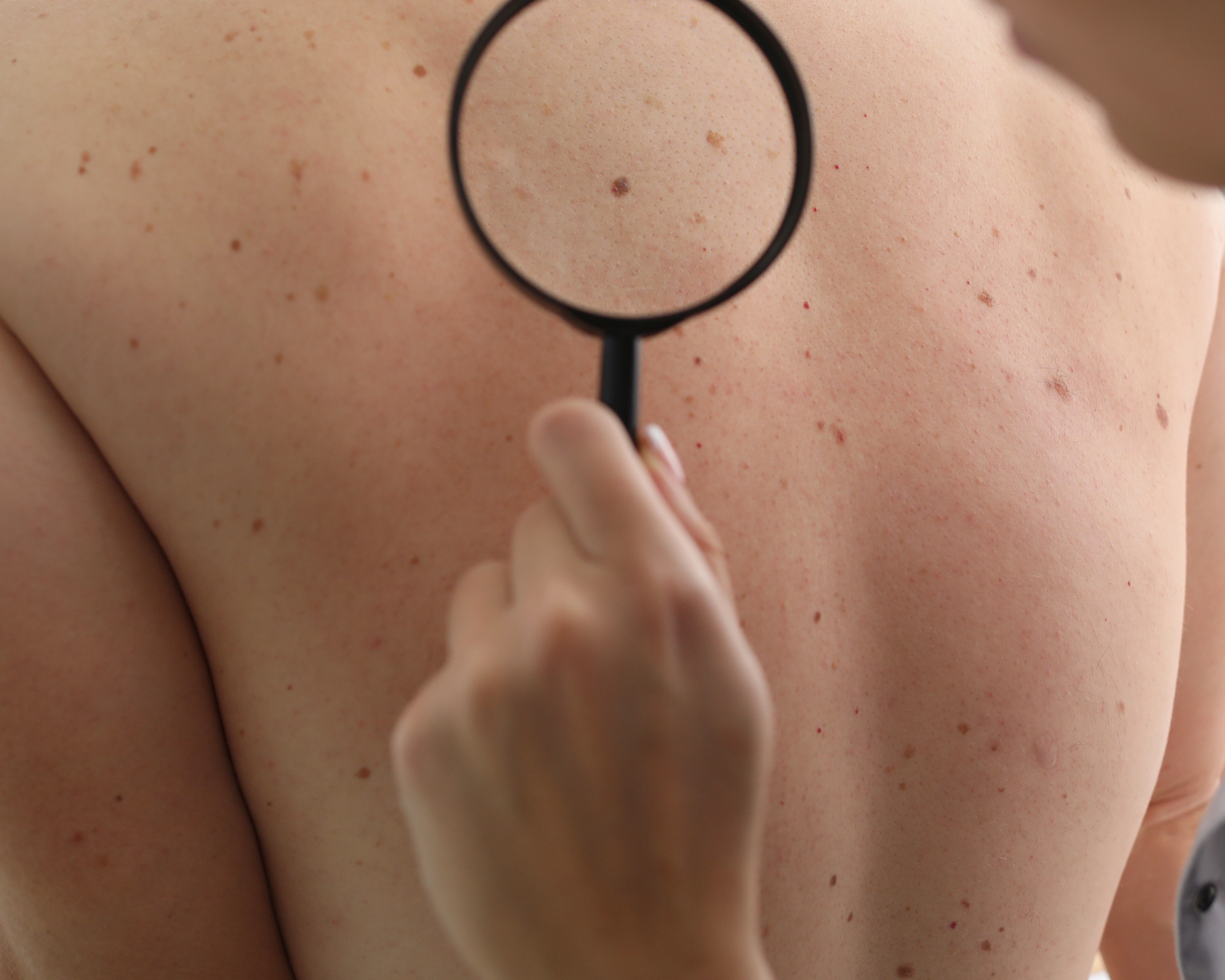 Procedimento dermatológico para remoção de lesão realizado por dermatologista em São Paulo