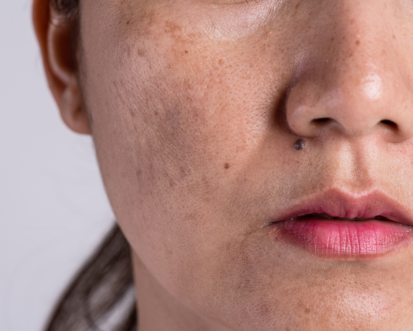 Tratamento de melasma em São Paulo com protocolos dermatológicos personalizados